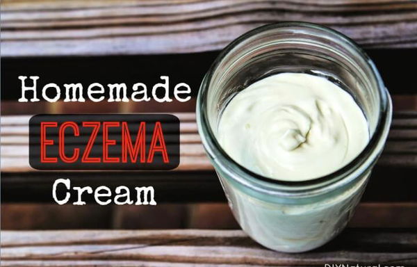 How to Make Homemade Natural Eczema Cream